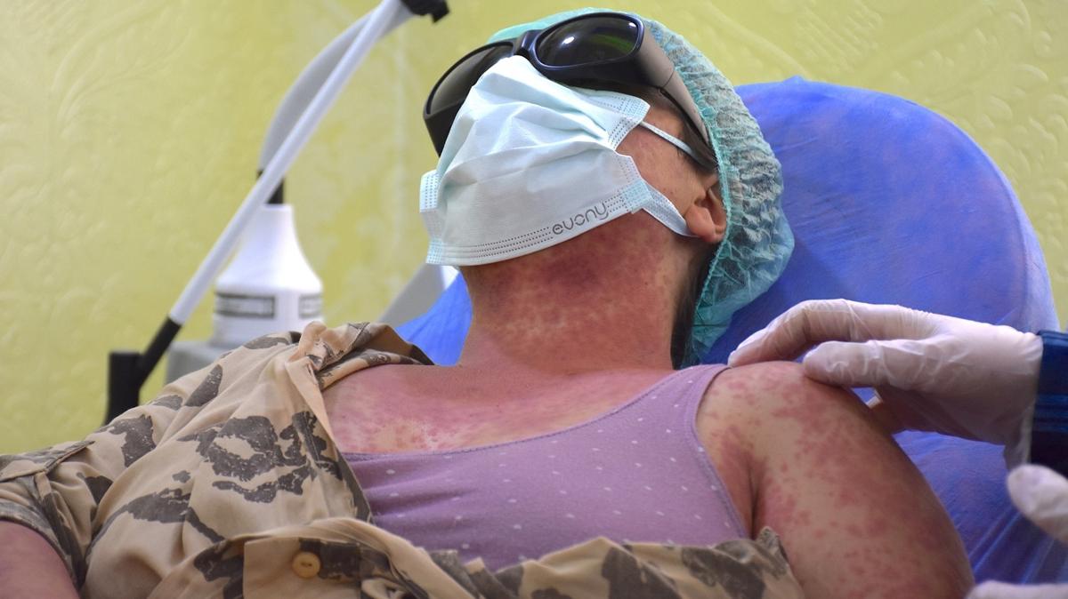 Srdkleri krem hayatlarn karartt: 4 kii hastanelik oldu