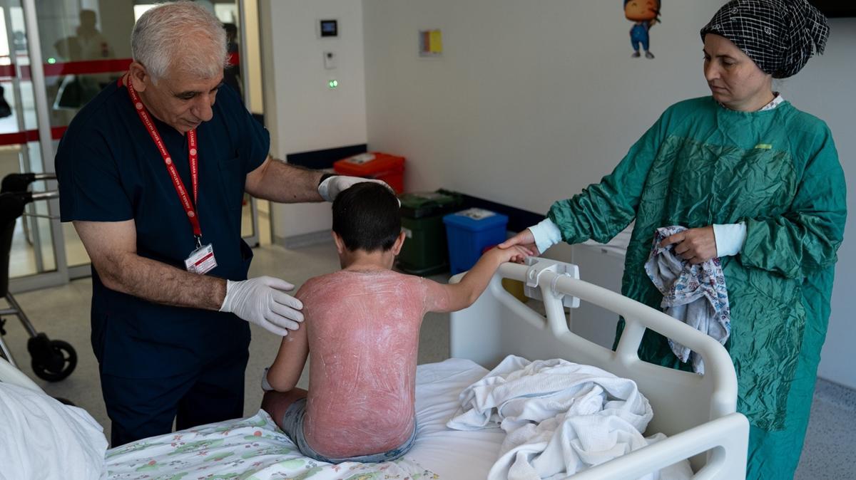 Gnete 4 saat kalan ocuk, ikinci derece yankla hastanelik oldu