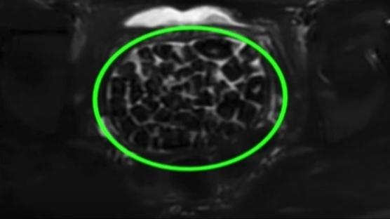 Böylesi literatürde yok: 21 yaşındaki genç kızın vücudundan 287 taş çıktı