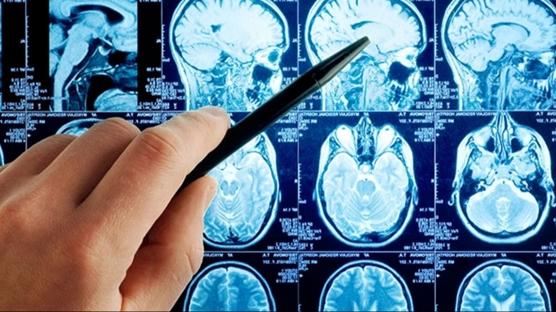 Dünyada sadece 13 kişide var: 'Genetik mutasyon' diyerek duyurdular