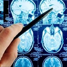 Dnyada sadece 13 kiide var: 'Genetik mutasyon' diyerek duyurdular