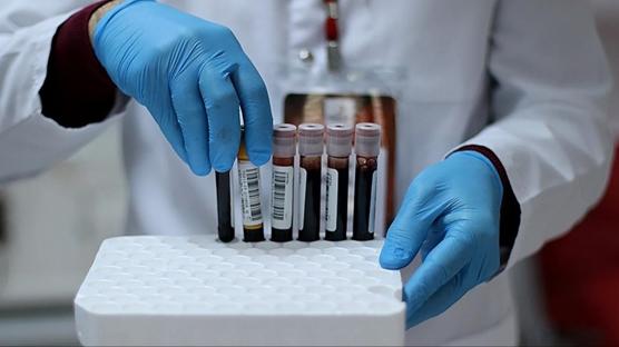 A kan grubuna sahip olanlar 60 yaşından önce inme geçirme riskiyle karşı karşıya