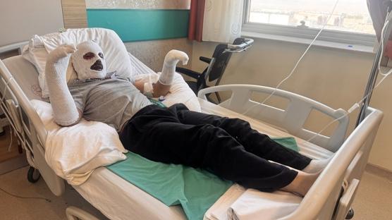 �ay demlemek isterken kabusu ya�ad�! V�cudunun d�rtte biri yand�