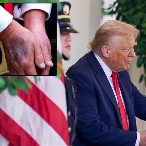 Trump'�n elindeki morluklar�n sebebi belli oldu: Kalbimden g�zel kan�n akmas�n� istiyorum