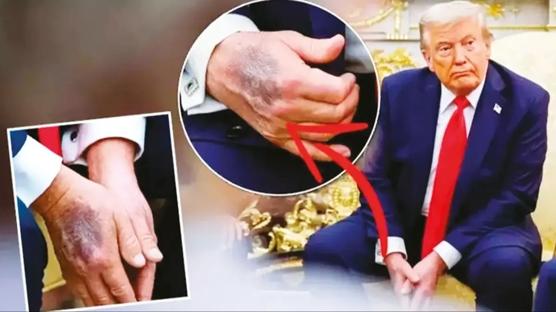 Trump elindeki morlukların nedenini açıkladı