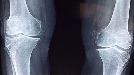 Eklem a�r�s� i�in en etkili tedavi hareket ve egzersiz