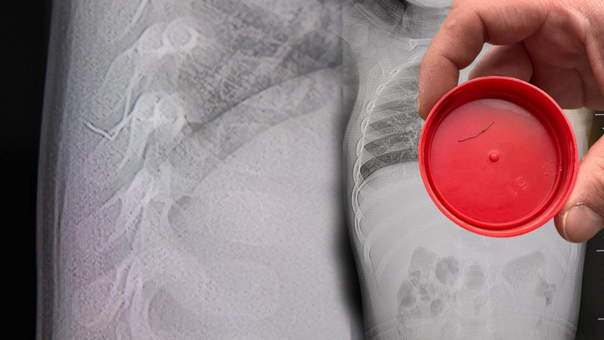 Yatarken ağlıyordu! Sırtından tel çıkarıldı