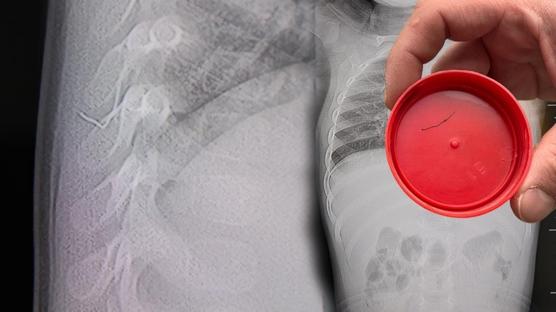 Yatarken ağlıyordu! Sırtından tel çıkarıldı