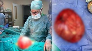 14 ya��ndaki �ocu�un karn�ndan 3.5 kilo kist ��kt�