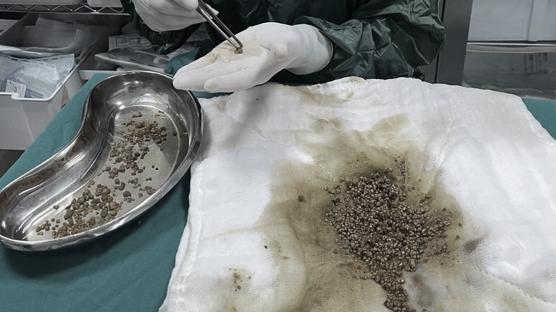 Uzman doktordan 'ilk kez kar��la�t�k' itiraf�: Safra kesesinden ��kanlar hayrete d���rd�