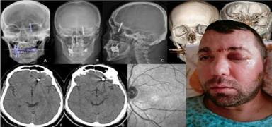 �ene kemi�ini delip kafatas�na sapland�